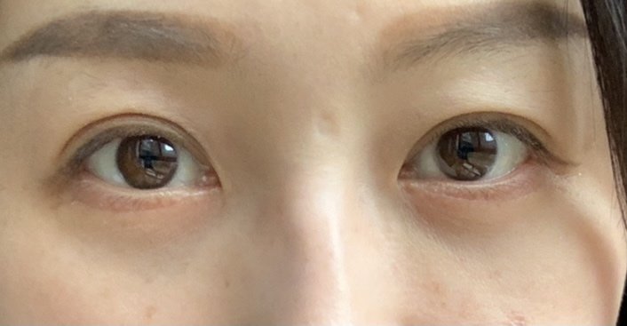 眼睛肿回事玩手机游戏怎么办_玩手机游戏眼睛肿怎么回事_眼肿跟玩手机有关系吗